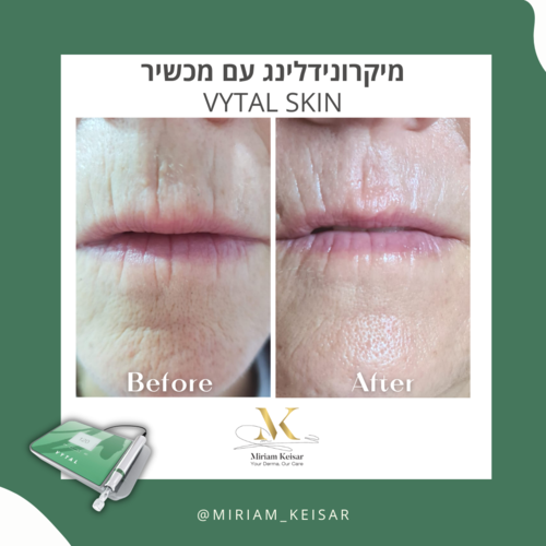 מכשיר ויטל סקין - מיקרונידלינג