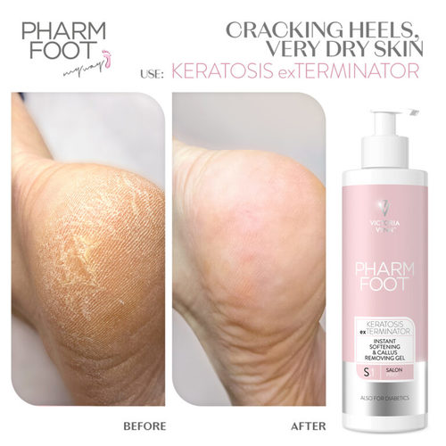 ג’ל ריכוך להסרת עור יבש ברגליים וקאלוס Pharm Foot | KERATOSIS exTERMINATOR