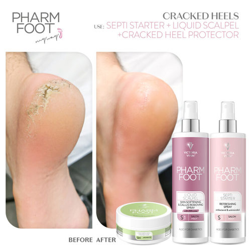 ג’ל ריכוך להסרת עור יבש ברגליים וקאלוס Pharm Foot | KERATOSIS exTERMINATOR
