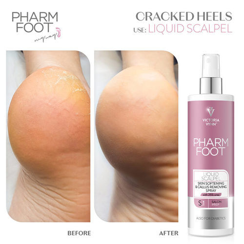 ספריי מרכך ומסיר יבלות קאלוס Pharm Foot | LIQUID SCALPEL