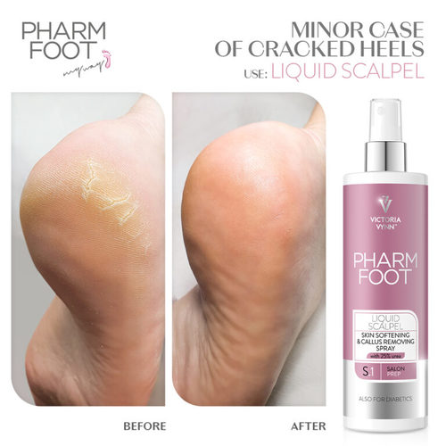 ספריי מרכך ומסיר יבלות קאלוס Pharm Foot | LIQUID SCALPEL