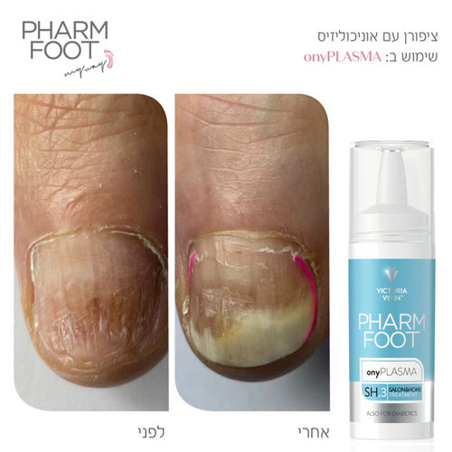 נוזל קולוסטרום לשיקום הציפורן לטיפול באוניכוליזיס Pharm Foot | onyPLASMA