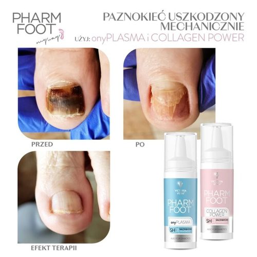 נוזל קולוסטרום לשיקום הציפורן לטיפול באוניכוליזיס Pharm Foot | onyPLASMA